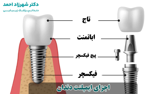 اجزای ایمپلنت دندان چیست؟