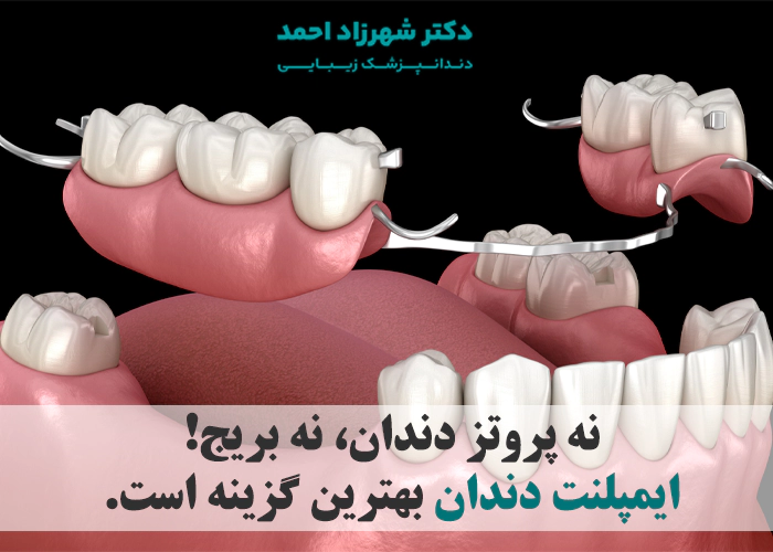ایمپلنت دندان بهتر است یا پروتز و بریج؟
