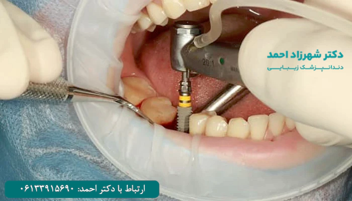 ایمپلنت دندان چه معایب و ریسک هایی دارد؟
