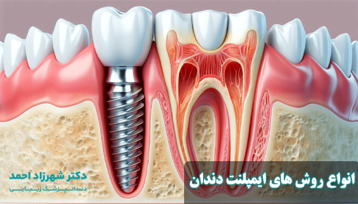 روش های ایمپلنت دندان در اهواز چیست؟