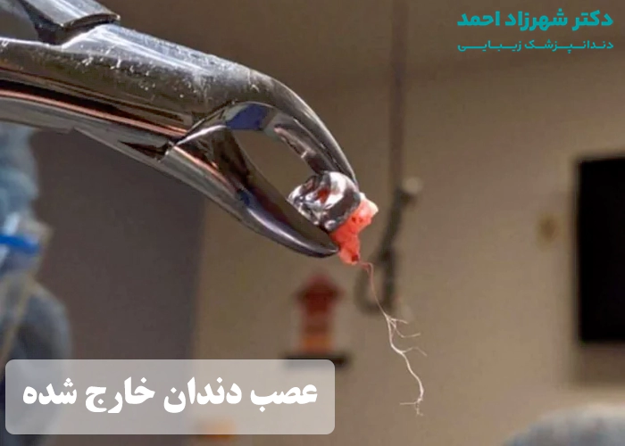 عکس عصب دندان بعد از عصب کشی