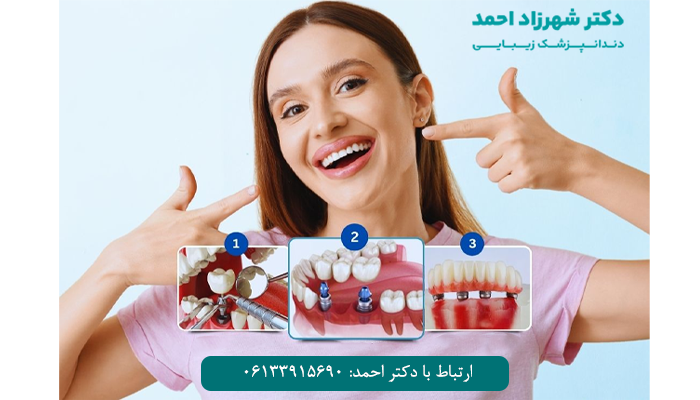 مراحل ایمپلنت دندان چیست؟