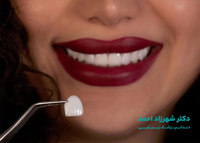 نمونه کار لمینت دندان دکتر شهرزاد احمد