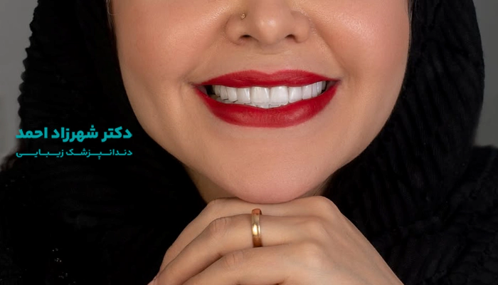 نمونه کارهای لمینت دندان دکتر شهرزاد احمد در اهواز