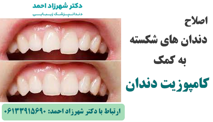 کامپوزیت دندان چه ایراداتی را رفع می کند؟