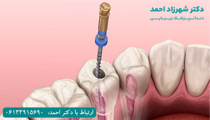 کدام روش عصب کشی دندان درد کمتری دارد؟