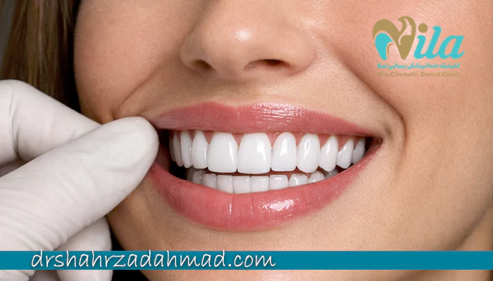 تفاوت هزینه لمینت دندان در اهواز و سایر شهرها