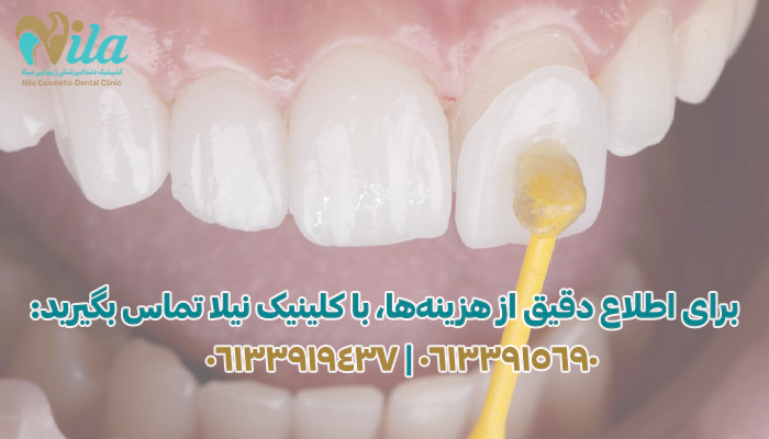 تماس با کلینیک نیلا برای قیمت لمینت دندان