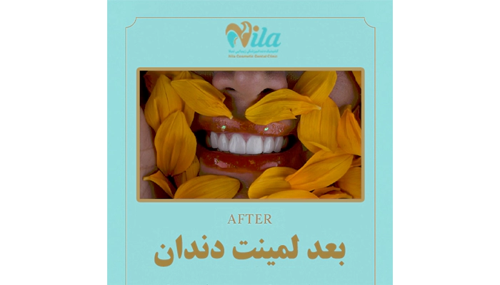 نمونه کار لمینت دندان