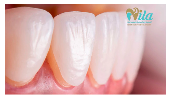 کدام لمینت برای افراد سیگاری مناسب است؟
