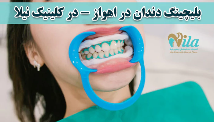 بلیچینگ دندان در اهواز - در کلینیک نیلا