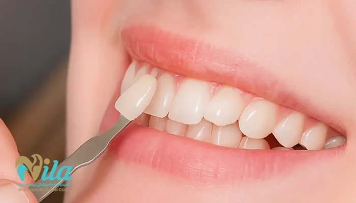 لمینت سرامیکی بهتر است یا کامپوزیت ونیر؟