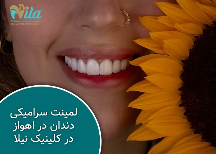 لمینت سرامیکی دندان در اهواز در کلینیک نیلا
