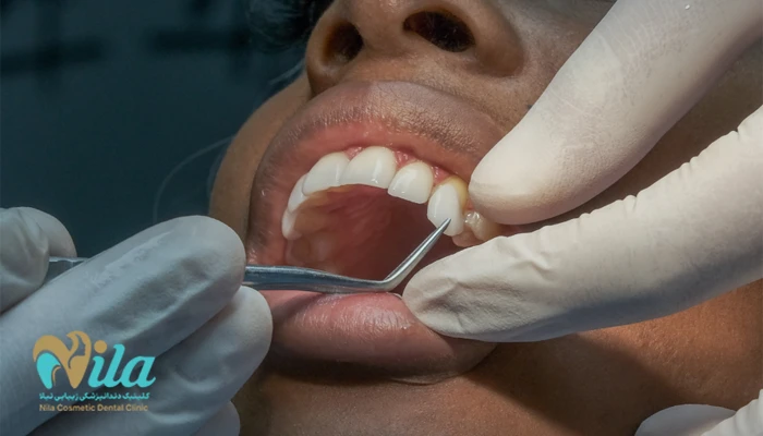 مراحل انجام لمینت سرامیکی دندان در اهواز چگونه است؟
