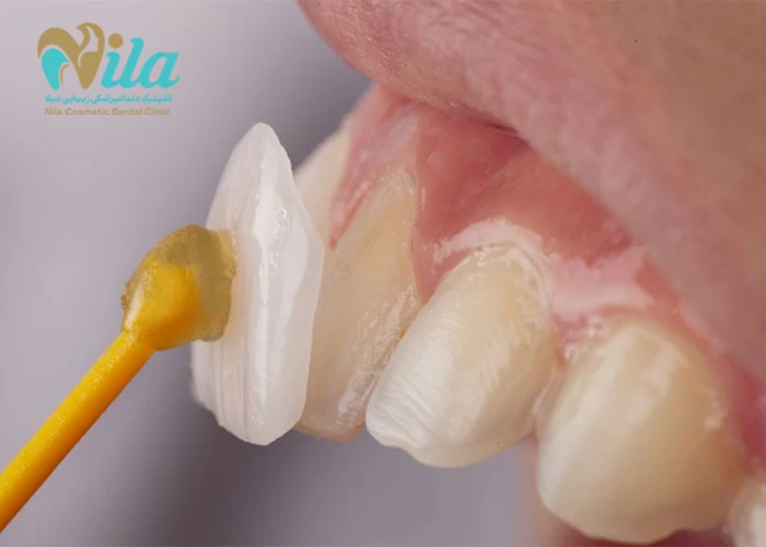 مزایا و معایب لمینت سرامیکی دندان چیست؟